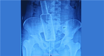 मन्सुरीको पेटमा कसले घुसाइदियो सिसाको बोतल ?