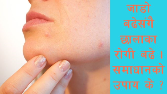 चिसो बढेसँगै छालामा सङ्क्रमणको खतरा, चिसोबाट छालालाई बसरी बचाउने ? 